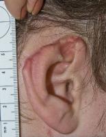 Ear defect